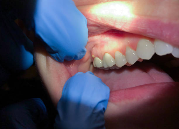Best Emergency Treatment for Toothache in Egan, LA